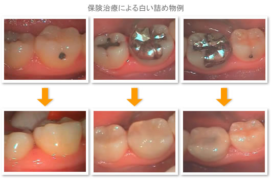 虫歯の治療例