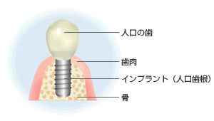 インプラントとは?
