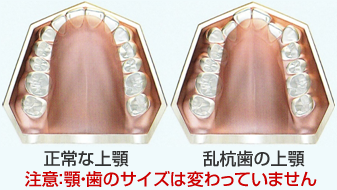 マウスピース矯正とは?