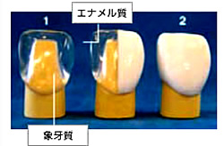 スライス矯正