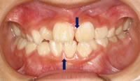 左右いずれかの奥歯または前歯が横にずれている