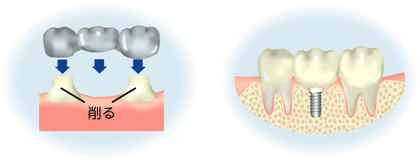 インプラント治療は、健康な歯を削りません