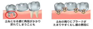 インプラントは、とっても長持ちします