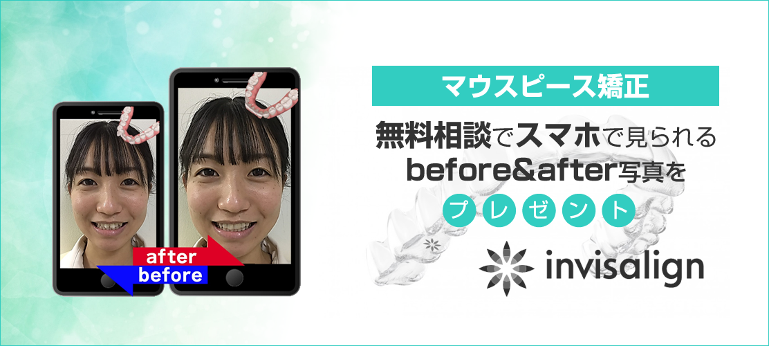 iTero導入キャンペーン