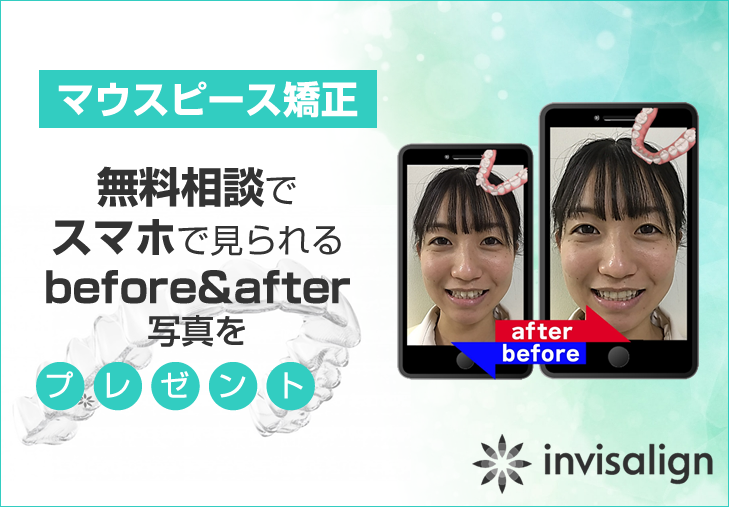 iTero導入キャンペーン
