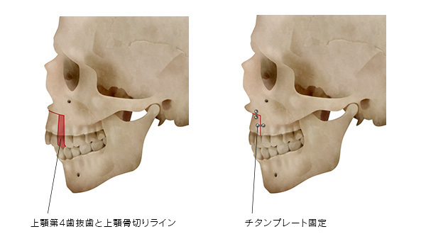 後戻りを防止する方法は？