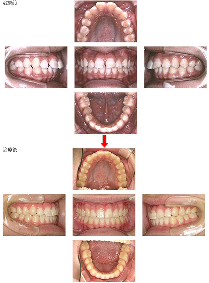 出っ歯
