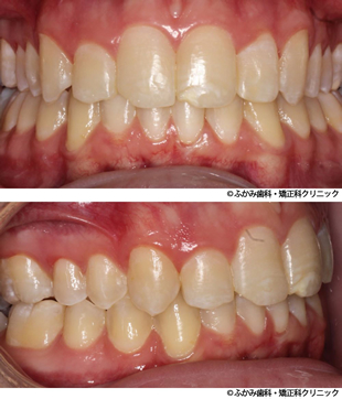 出っ歯・八重歯のマウスピース矯正+加速装置