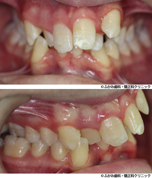 出っ歯・八重歯のマウスピース矯正+加速装置