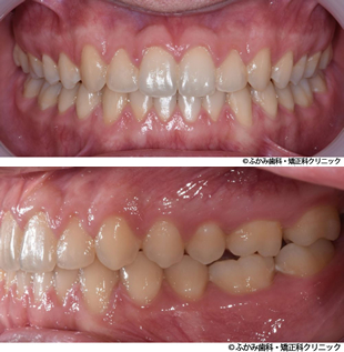 受け口・すきっ歯のマウスピース矯正+加速装置