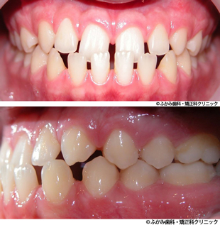 受け口・すきっ歯のマウスピース矯正+加速装置