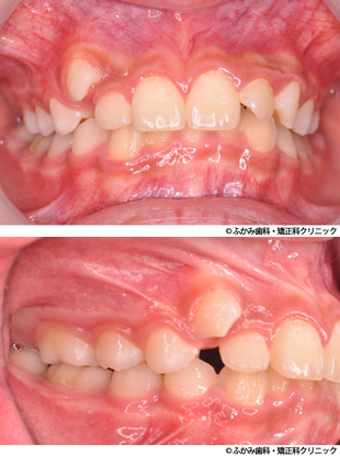 マウスピー矯正(八重歯・噛み合わせが深い・顎のずれ)
