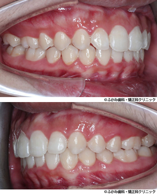 マウスピー矯正(八重歯・噛み合わせが深い・顎のずれ)