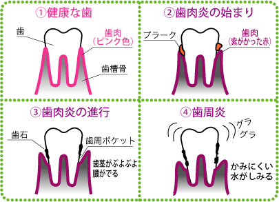 大和高田市 矯正歯科 ふかみ歯科 歯茎は健康のバロメーター