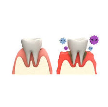 歯周病予防には小腸ケアが効果的！？