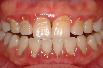 不健康な歯茎と健康な歯茎の違い